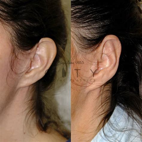 Nyc Ear Plastic Surgery New York Cosmetic Ear Surgeon Ues