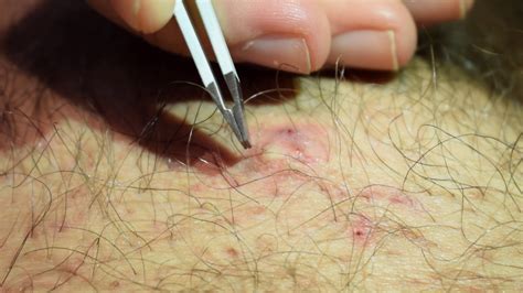 The hair can also fail to project out through its pore under skin and thus curl back. Ingrown hair removal - YouTube