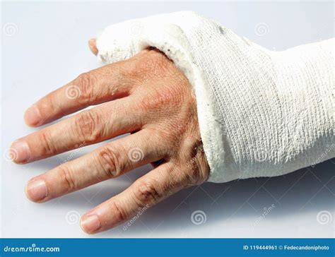 Hand With Fractured Bones In The Orthopedic Hospital Emergency Stock