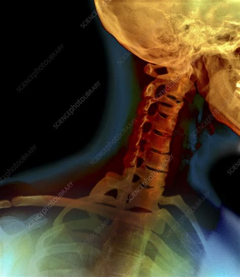 Osteoarthritis Of The Neck X Ray Stock Image M110 0685 Science