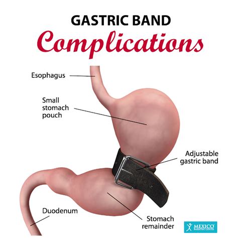 Gastric Banding Lap Band Surgery Risks Complications