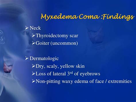 Hypothyroidismand Myxedema Crisis