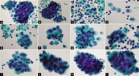 The Panorama Of Different Faces Of Mesothelial Cells Cytojournal