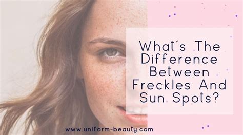 The Difference Between Freckles And Moles What You Need To Know Justinboey