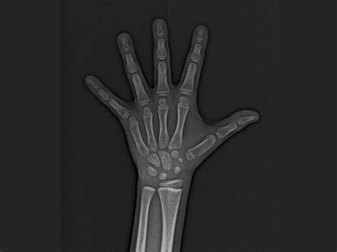 Radiografia de mão e punho e curva de crescimento CADI Centro