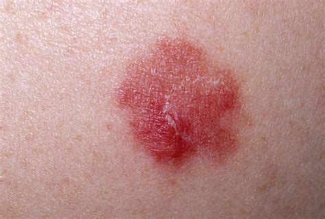 Skin Manifestations Of Chronic Hepatitis C Virus Infection Dermatology Advisor