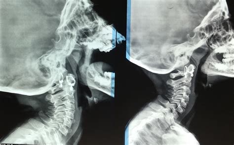 Ent Surgeons Blog X Ray Adenoid Which View Is Better Open Mouth Or