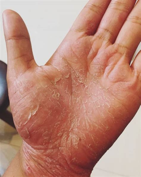 Psoriasis On Hands And Feet Why And How To Prevent It Dermalare