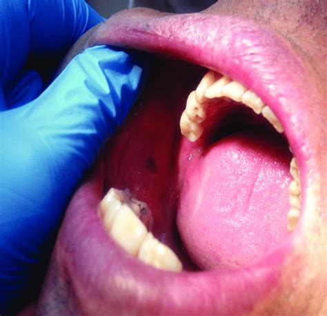 Melanotic Macule Detected In The Buccal Mucosa Of The Patient Who