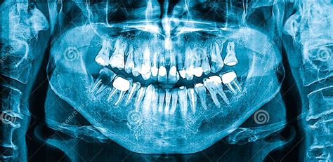Panoramic Dental X Ray Of Woman Jaw Stock Photo Image Of
