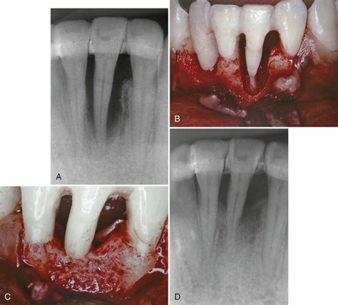 Treatment Of Aggressive And Atypical Forms Of Periodontitis