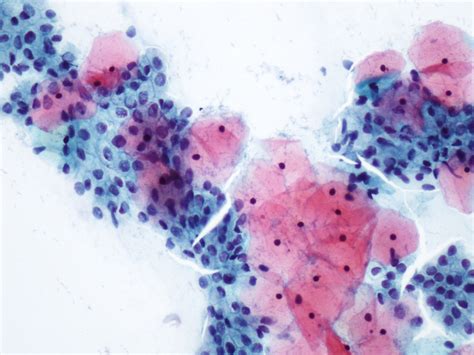 O Que Significa Células Glandulares Endocervicais Presentes No Papanicolau