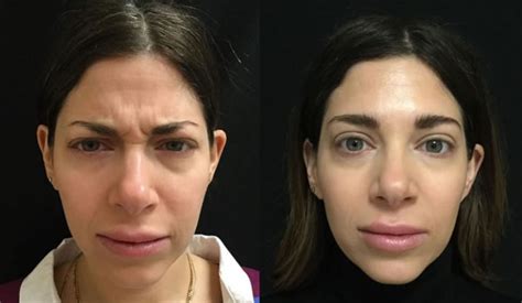 35 year old treated with botox injections (forehead, glabella & crows feet). Patient received Juvederm for lips and Botox injections ...