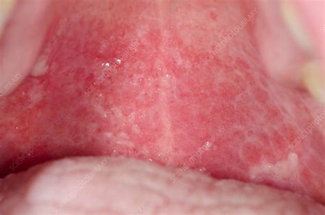 Lichen Planus In The Mouth Stock Image C0130919 Science Photo