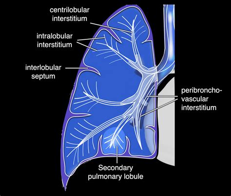 Interstitial Lung Disease Radiology Assistant Quotes Update