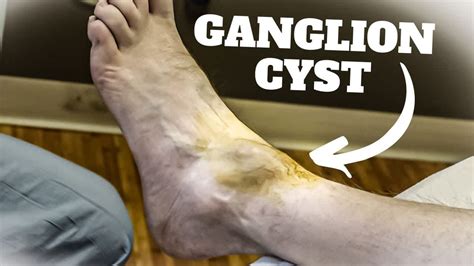 Ganglionic Cyst Toe Foot Ankle Home Remedy Treatment Guide