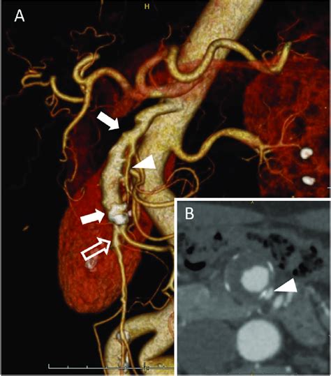 Preoperative Computed Tomography Angiography A A Volume Rendered Download Scientific Diagram