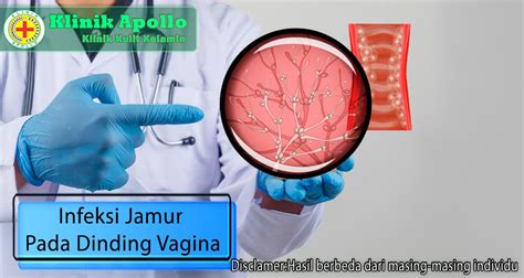 Infeksi Jamur Pada Dinding Vagina Apa Penyebab Dan Gejalanya Blog By Klinik Apollo