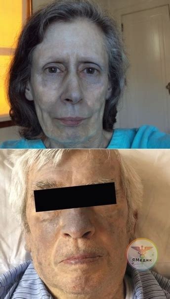 Change In Skin Color From Amiodarone Against The Background Of Taking