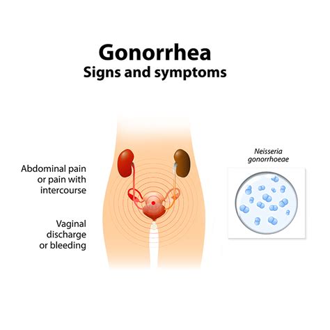 Gonorrhea Know The Warning Signs Symptoms And How To Protect Yourself