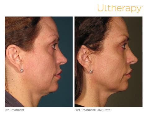 Ultherapy Minneapolis Ultherapy Treatment Skin Rejuvenation Clinic