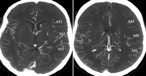 Assessment Of Intracranial Collaterals On Ct Angiography In Anterior