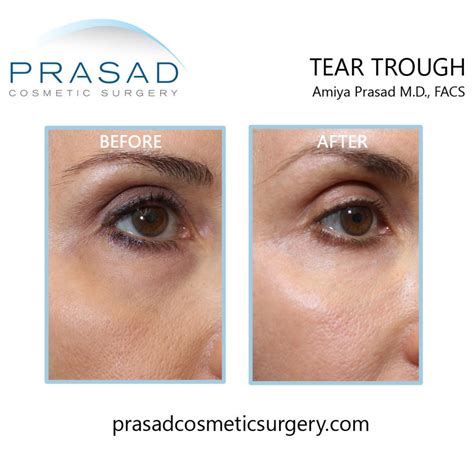 Under Eye Filler For Hollow Eyes Tear Troughs And Under Eye Bags