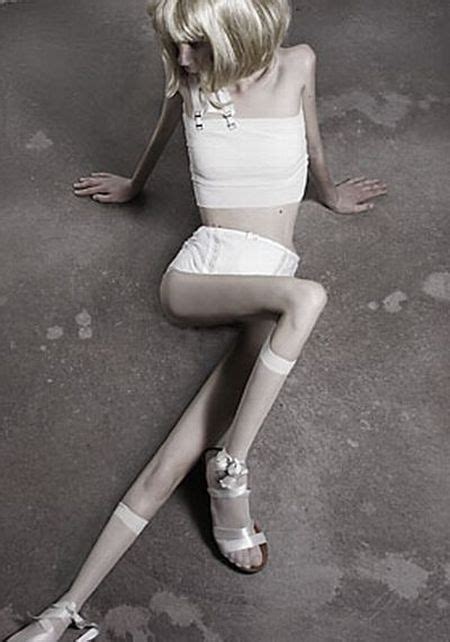 Anorexia Its Terrifying Pics Izismile