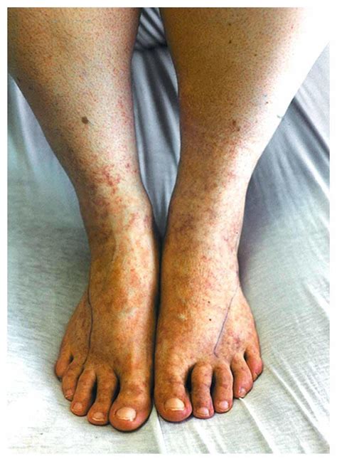Case 9 2007 — A 27 Year Old Woman With Pain And Swelling Of The Legs Nejm