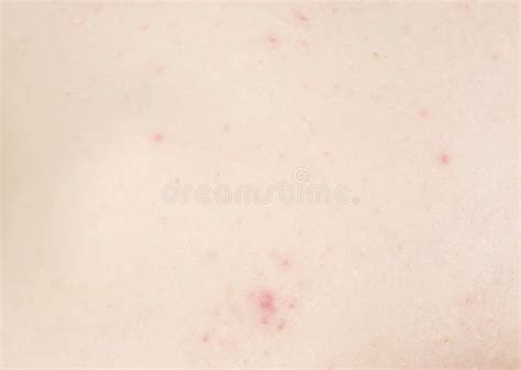 White And Red Pimples And Acne On The Man S Back Stock Image Image