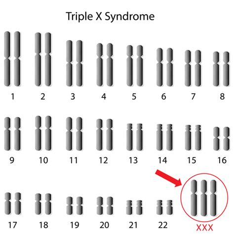 Triple X Syndrome Medlineplus Genetics