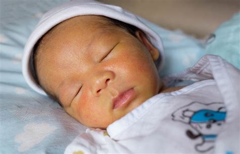 Neonatal Jaundice Explained For New Moms And Dads The Pulse