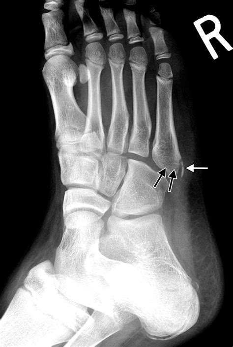 Acute Fractures And Dislocations Of The Ankle And Foot In Children