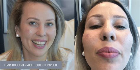 We did not find results for: Under Eye Filler: Misconceptions & Results - My Cancer Chic