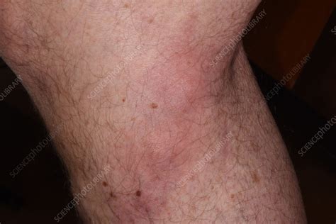 Thrombophlebitis Of A Leg Vein Stock Image C0564236 Science