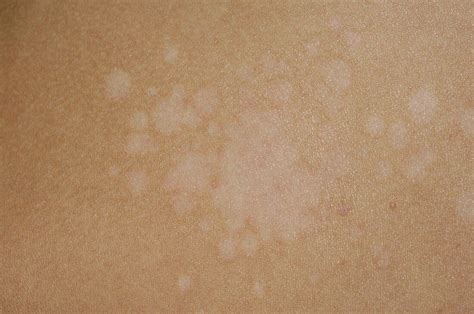 Pityriasis Versicolor Of The Skin Acheter Une Photo Science Photo Library