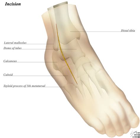Ankle Anterolateral Approach Approaches Orthobullets