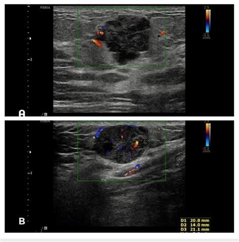 A Ultrasound Left Breast Revealed An Indeterminate Lesion Measuring 22