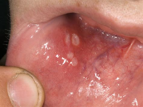 Ulcer At Roof Of Mouth Home Interior Design