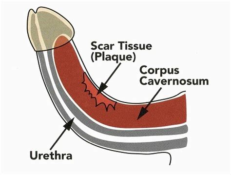 Peyronies Disease Images