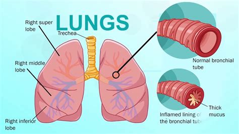 What Is Bronchitis Youtube