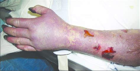 Rocky mountain spotted fever is a disease carried by ticks that can be fatal if not treated. Gangrene of the digits in a patient with late-stage Rocky ...
