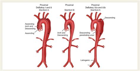 Aortic Dissection Classification Debakey And Stanford Classifications