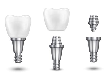 Tooth Implant Vector Illustration Dentalhu