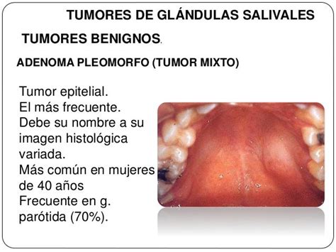 Tumores De Glandulas Salivales