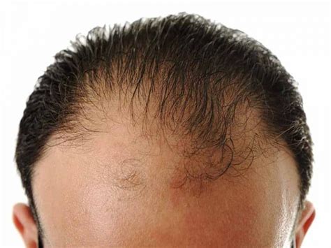 Male Pattern Baldness Definition Causes And Solutions Layla Hair