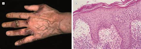 Mycosis Fungoidestype Cutaneous T Cell Lymphoma And Neutrophilic