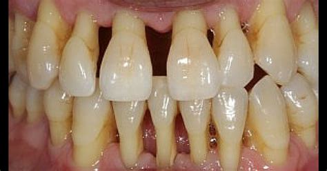 Find deals on products in personal care on amazon. How Receding Gums Can Totally Ruin Your Teeth | Institute ...