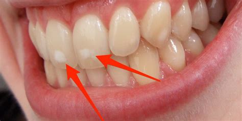 Protect Your Smile From White Spots Oral And Maxillofacial Surgery In