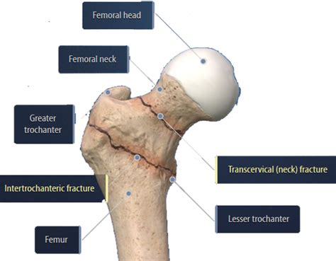 Hip Fracture Center Atlanta Bone And Joint Specialists